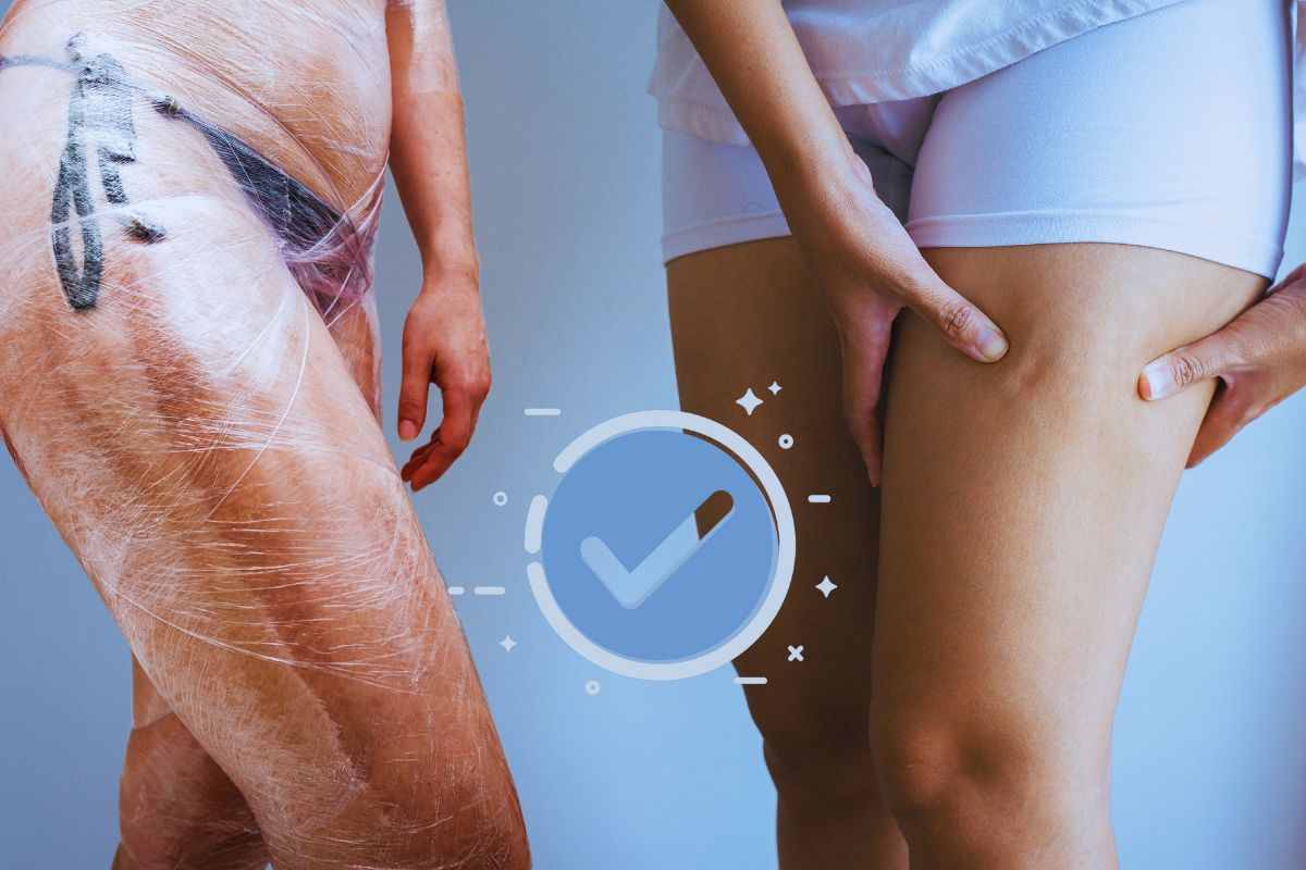 Rimedio contro la cellulite